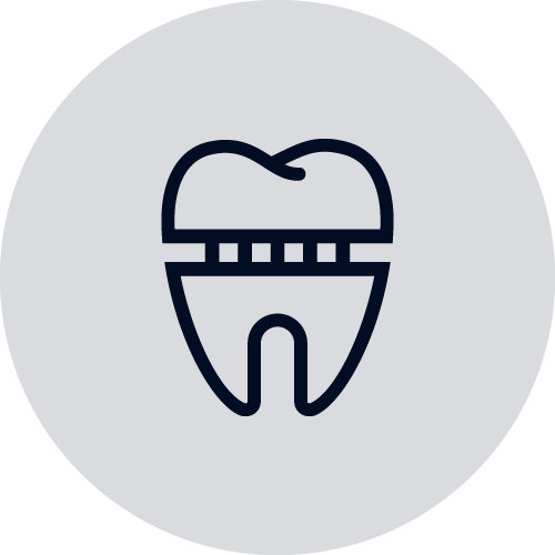 Kronen, bruggen en facings